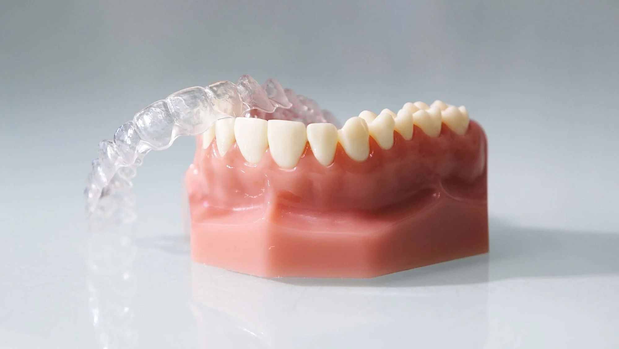 Transparente Invisalign-Schiene auf einem Zahnmodell
